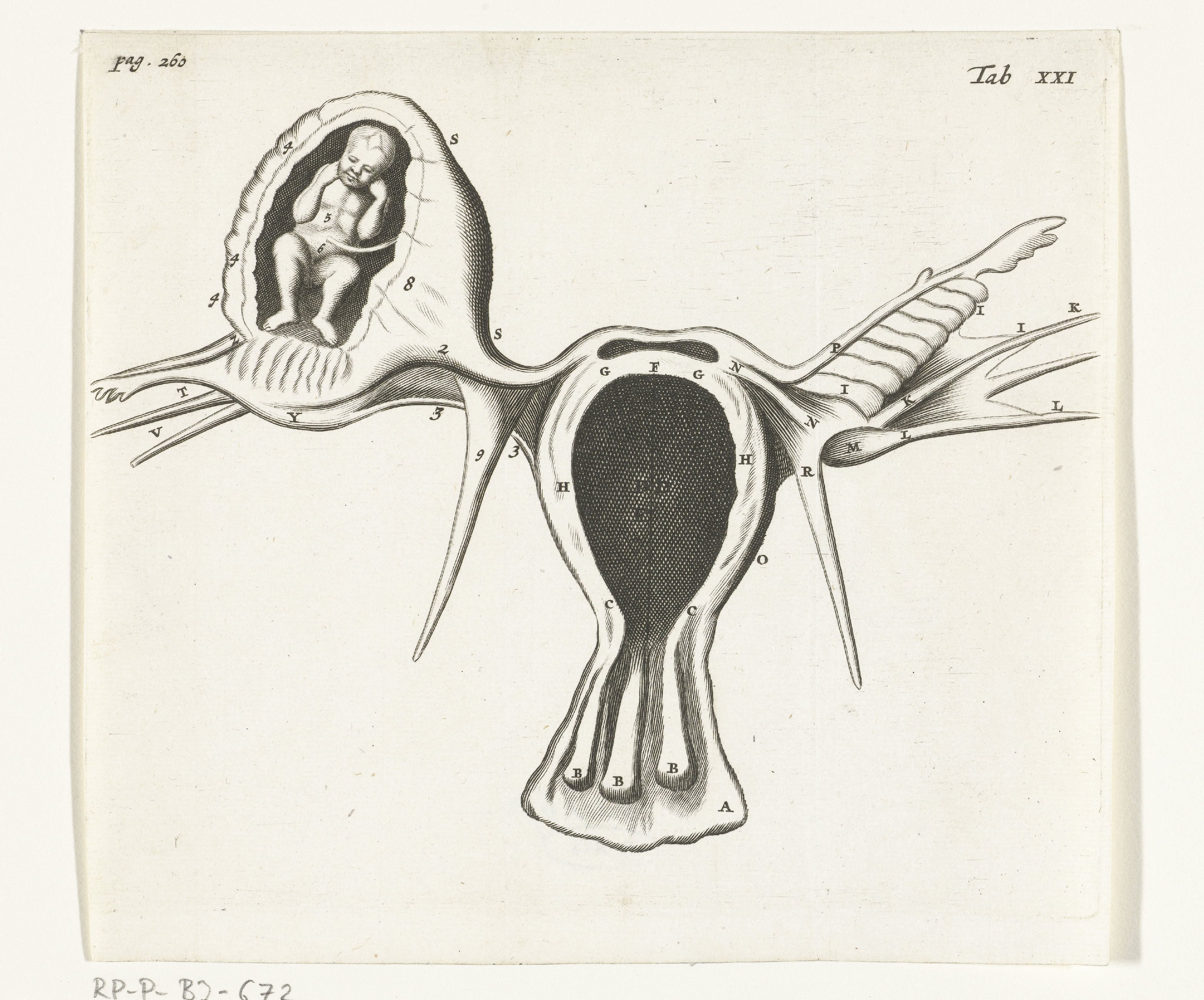 Anatomical depiction of an ectopic pregnancy