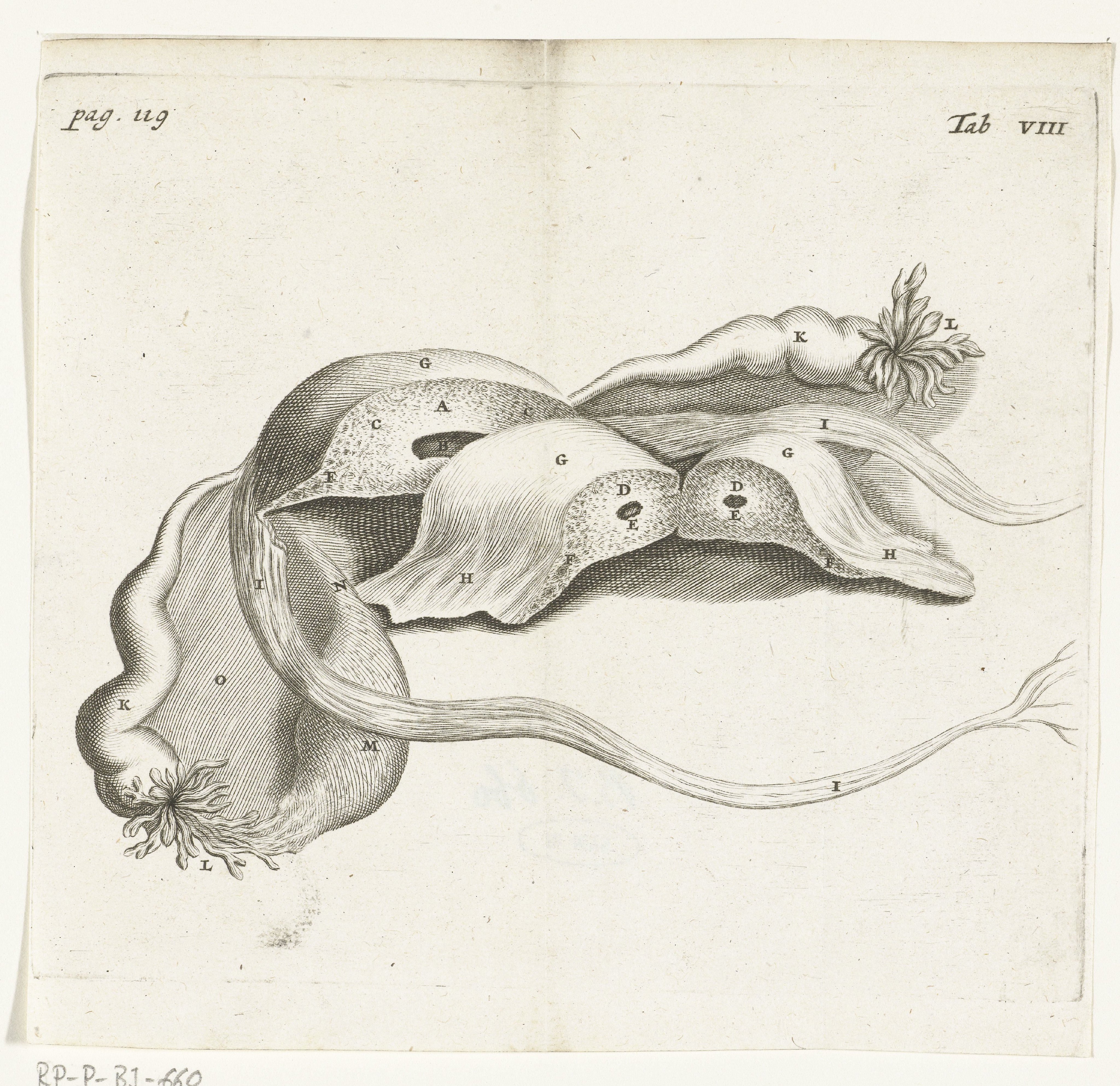 Anatomical depiction of an ectopic pregnancy