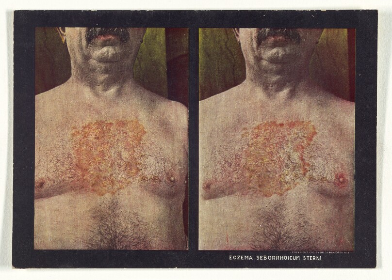 Eczema Seborrhoicum