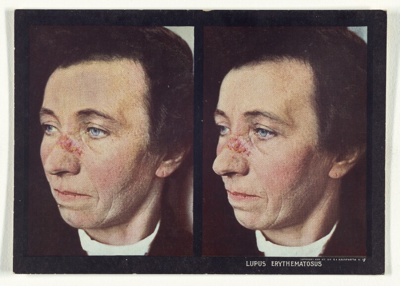 Lupus Erythematosus
