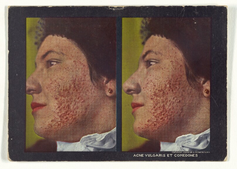 Acne Vulgaris et Comedones