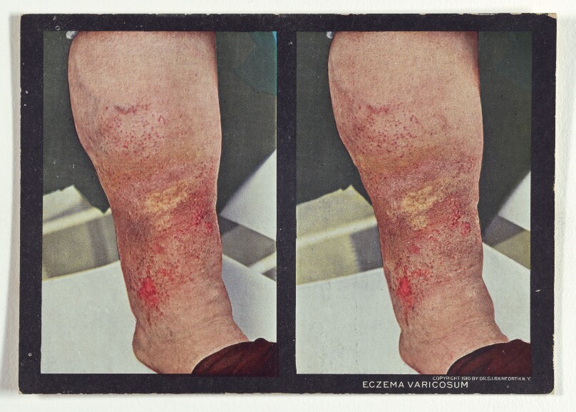 Eczema Varicosum.