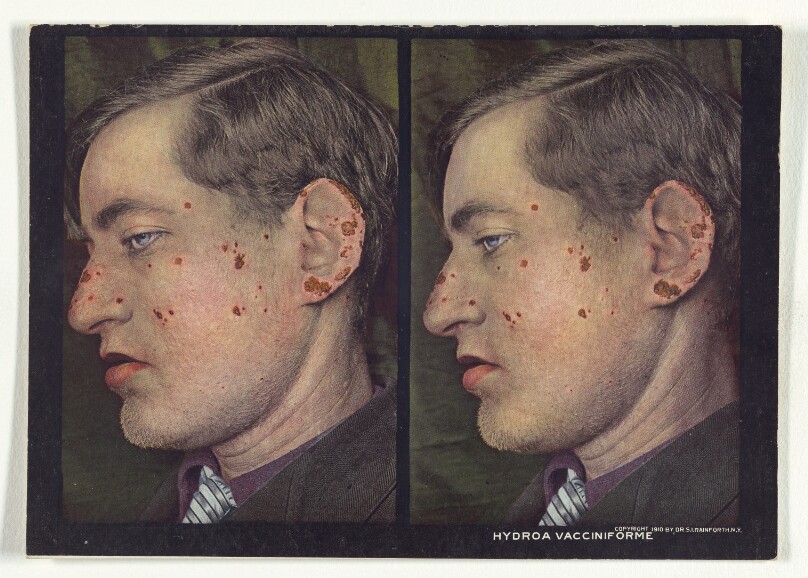 Hydroa Vacciniforme