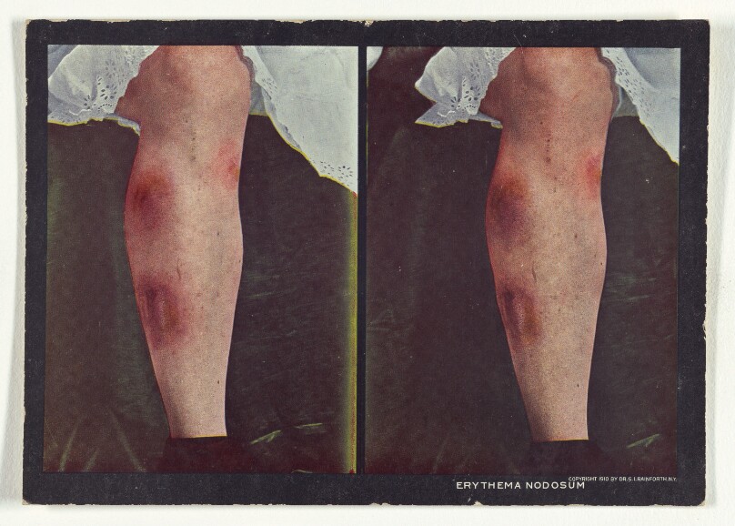 Erythema Nodosum