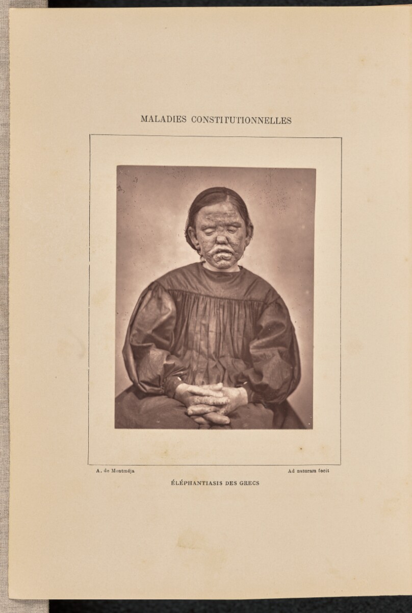 Éléphantiasis des grecs