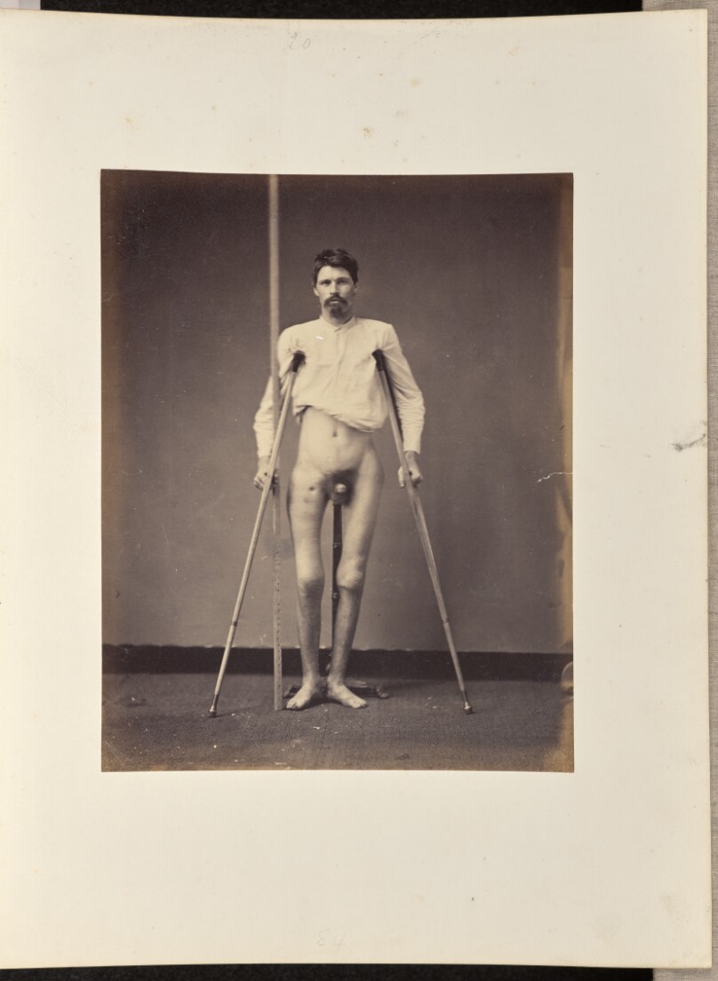 United Gunshot Fracture of the Shaft of the Right Femur