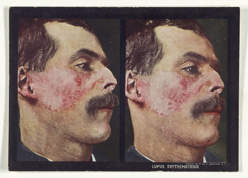 Lupus Erythematosus