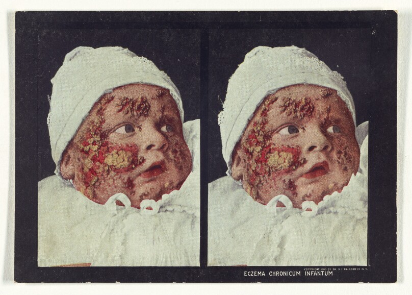 Eczema Chronicum Infantum