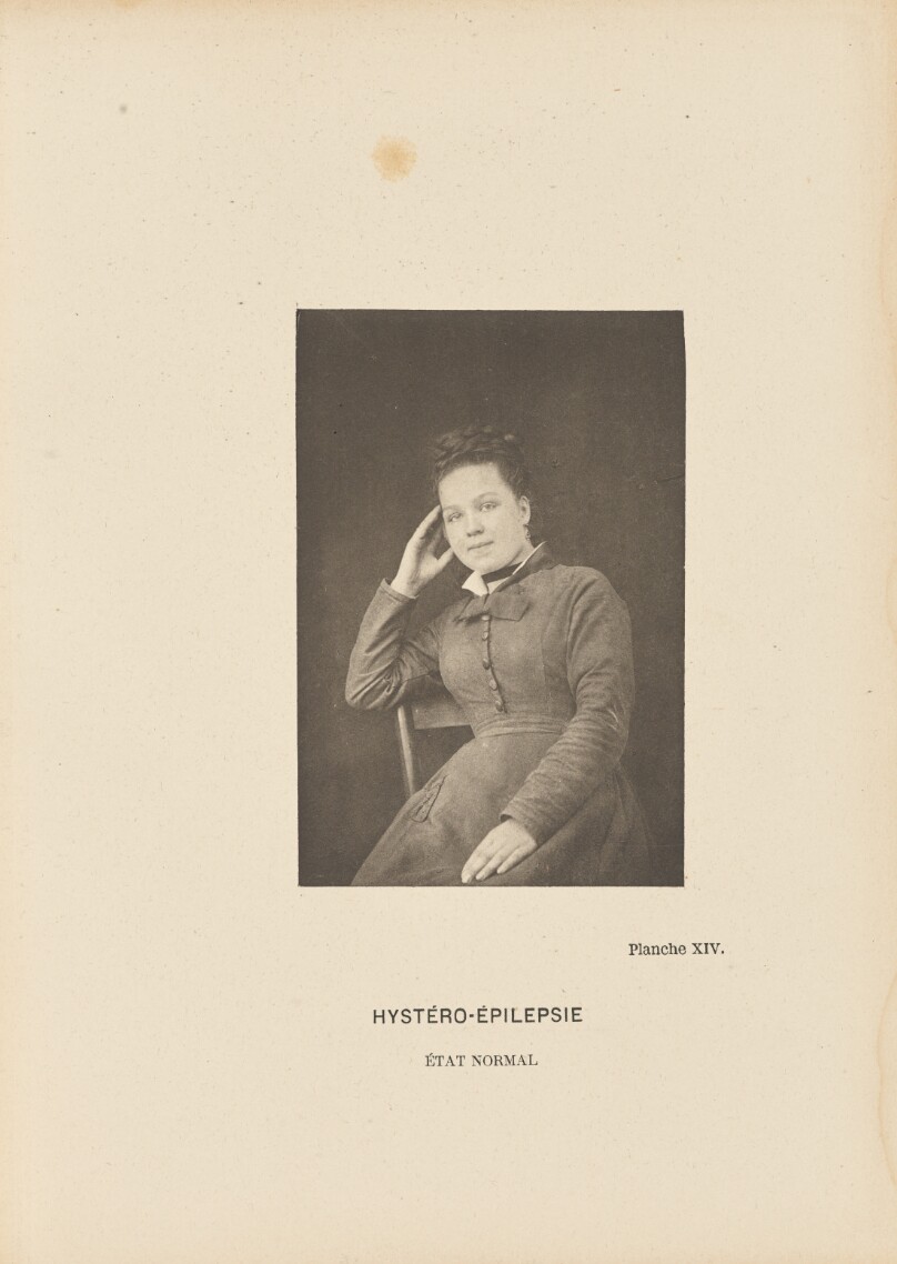 Hystéro-Épilepsie État Normal