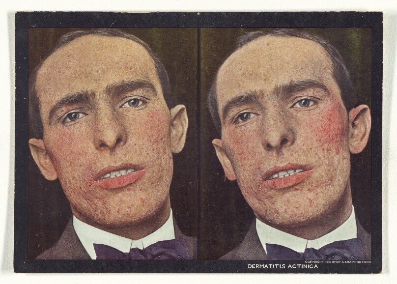 Dermatitis Actinica