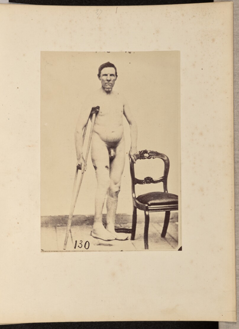 Consolidated Gunshot Fracture of the Middle Third of the Right Femur