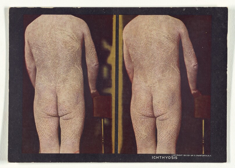 Ichthyosis