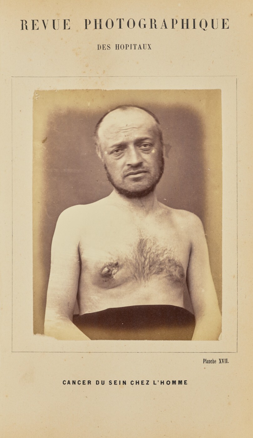 Cancer du sein chez l'homme