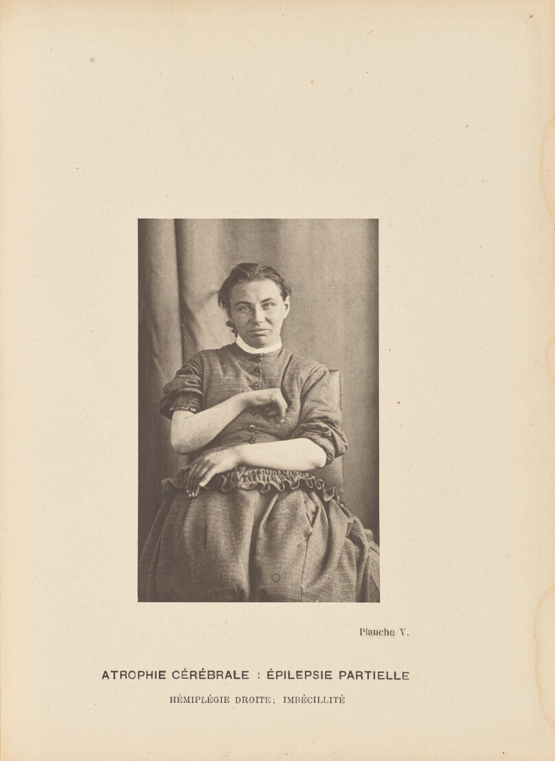 Atrophie Cérébrale: Épilepsie Partielle Hémiplégie Droite; Imbécillité