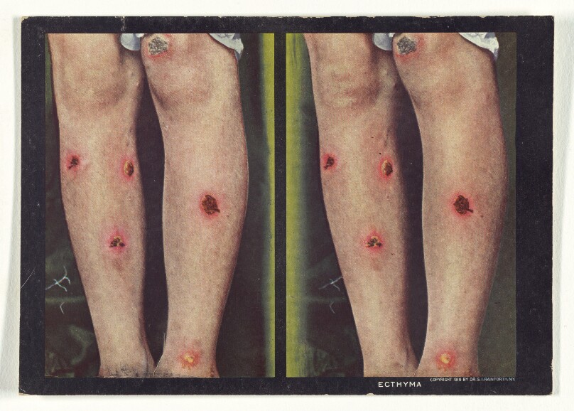 Ecthyma