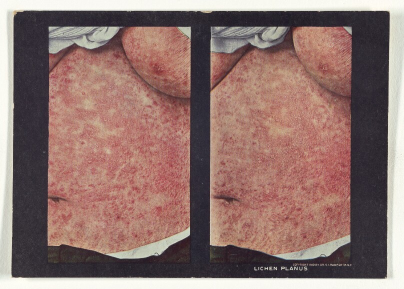 Lichen Planus