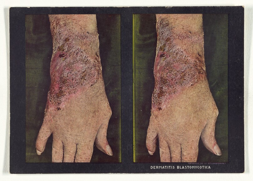 Dermatitis Blastomycotica