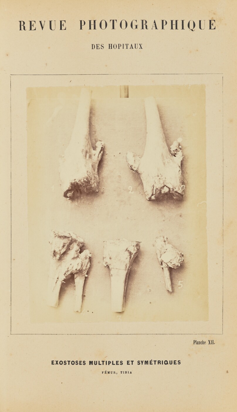 Exostoses multiples et symétriques, fémur, tibia