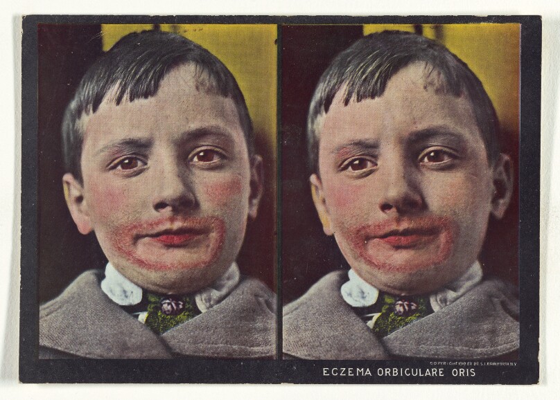 Eczema Orbiculare Oris