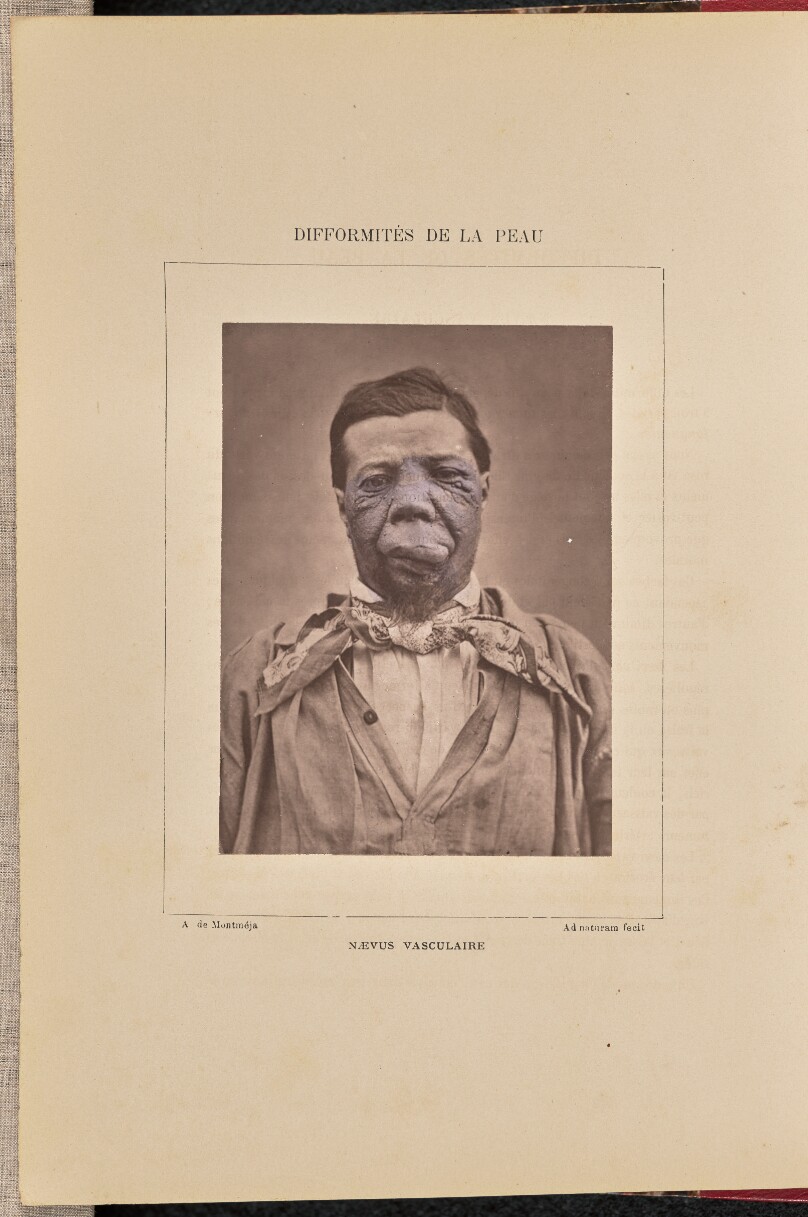 Nævus vasculaire