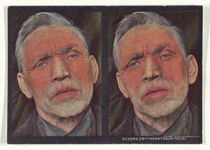Eczema Erythematosum Faciei
