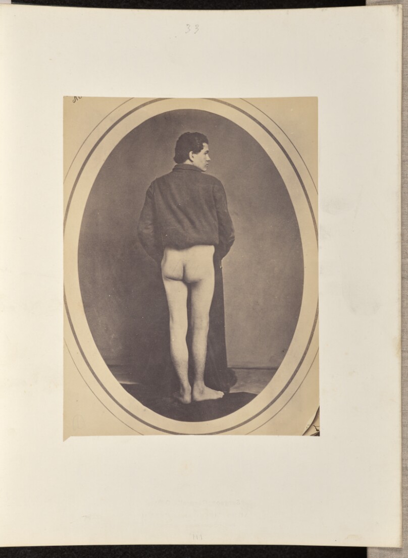 Consoslidated Gunshot Fracture of the Upper Third of the Right Femur