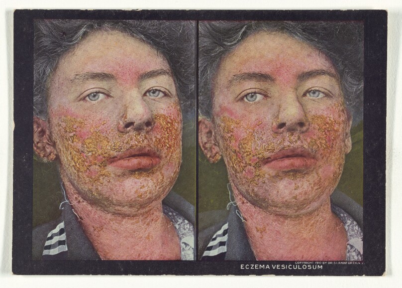 Eczema Vesiculosum