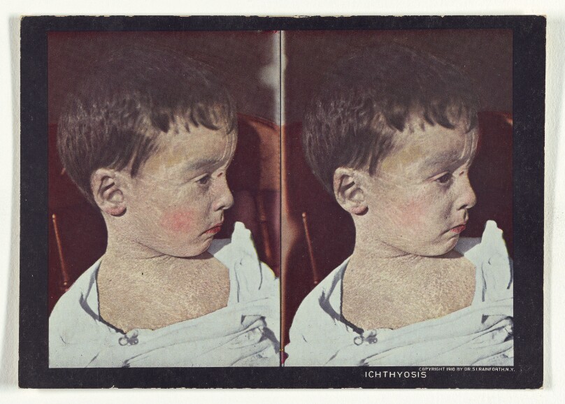 Ichthyosis