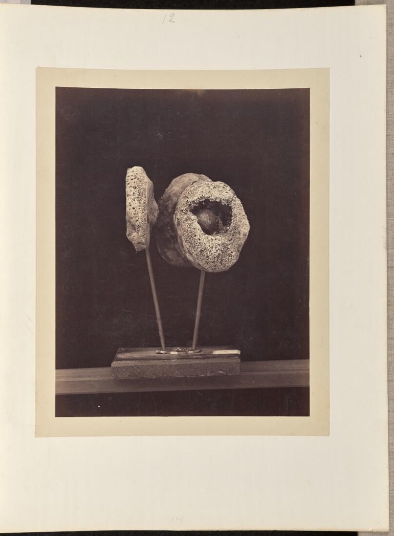 Excised Knee-joint. A Round Musket Ball in the Inner Condyle of the Right Femur