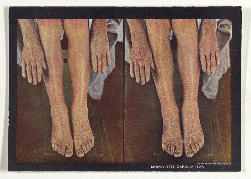 Dermatitis Exfoliativa