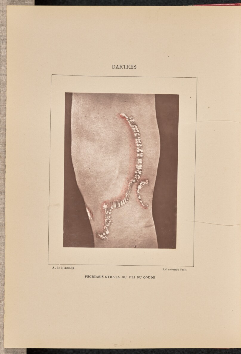 Psoriasis gyrata du pli du coude