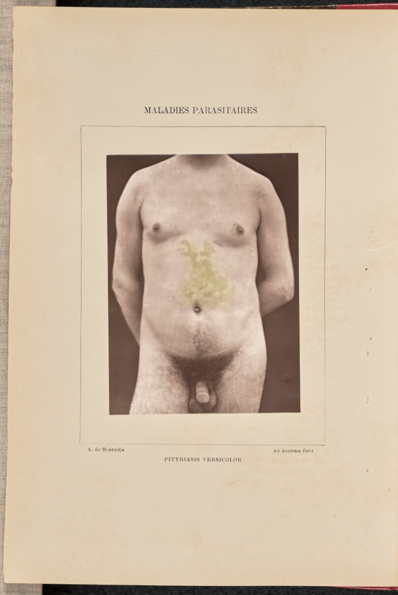 Pityriasis versicolor