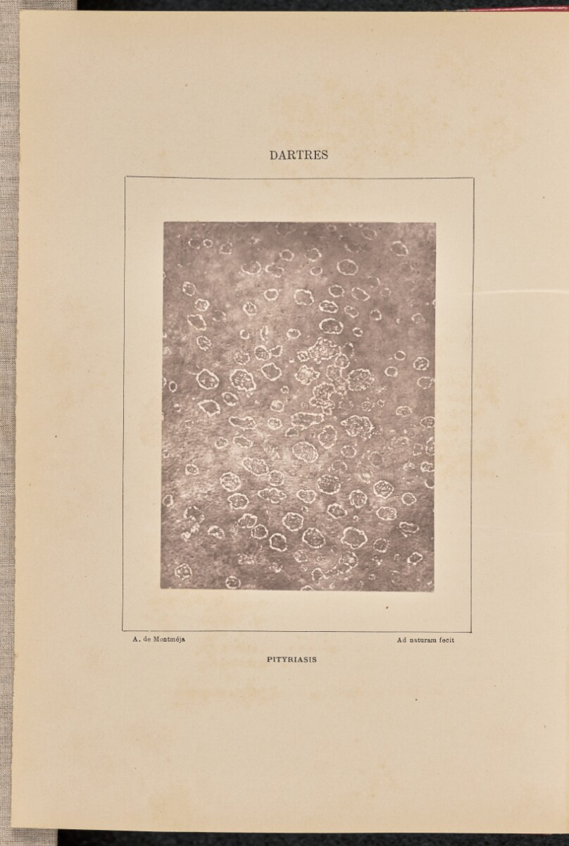 Pityriasis