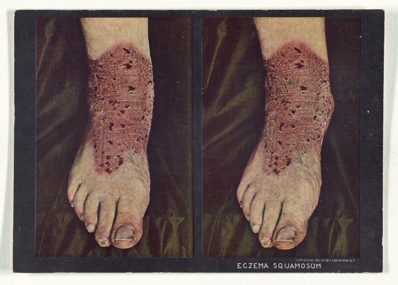 Eczema Squamosum.