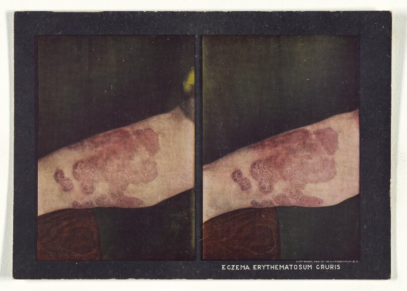 Eczema Erythematosum Cruris