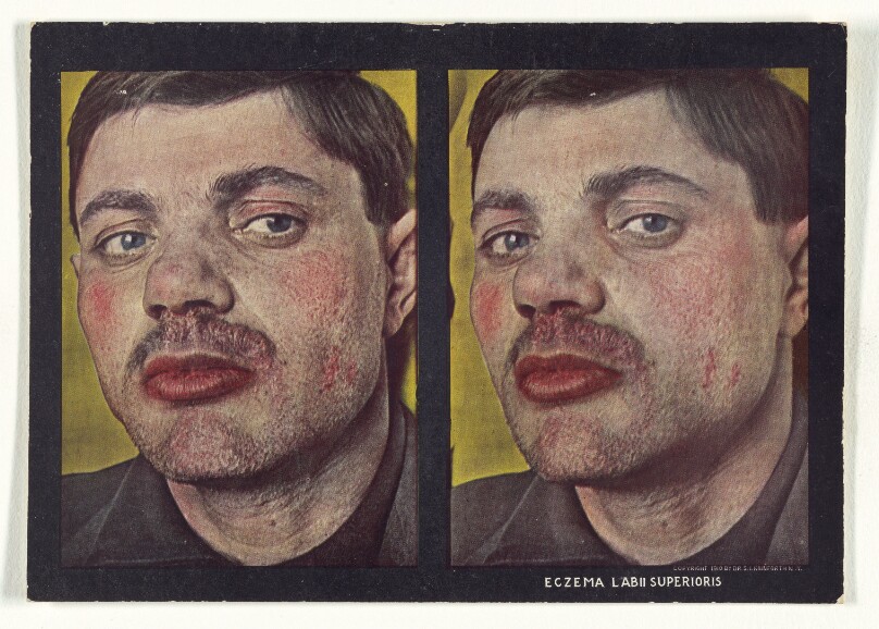 Eczema Labii Superioris