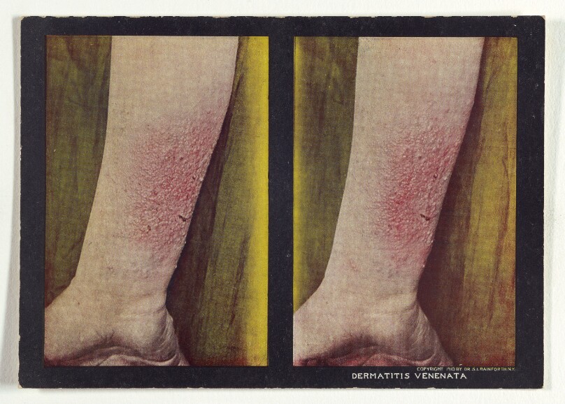 Dermatitis Venenata