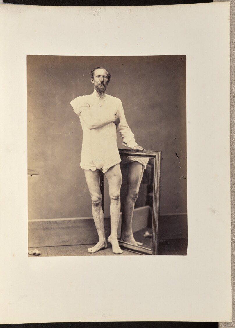 Consolidated Gunshot Fracture of the Middle Third of the Left Femur