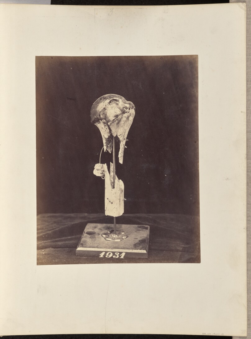Excised Head and Comminuted Upper-Portion of Shaft of Left Humerus, with a Conoidal Musket Ball