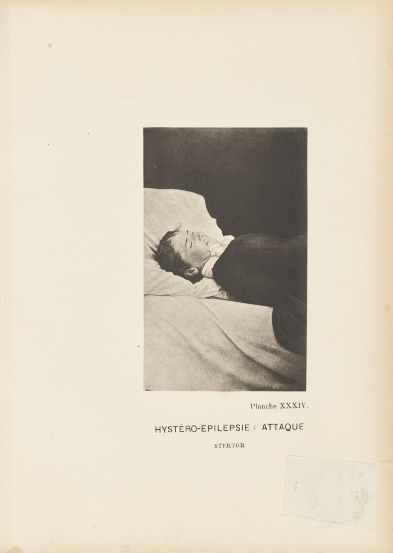 Hystéro-Épilepsie: Attaque Stertor