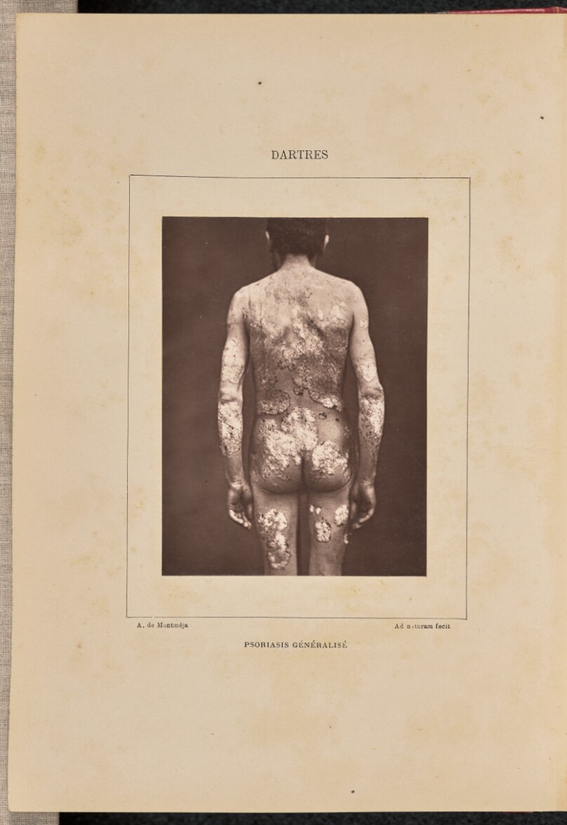 Psoriasis généralisé