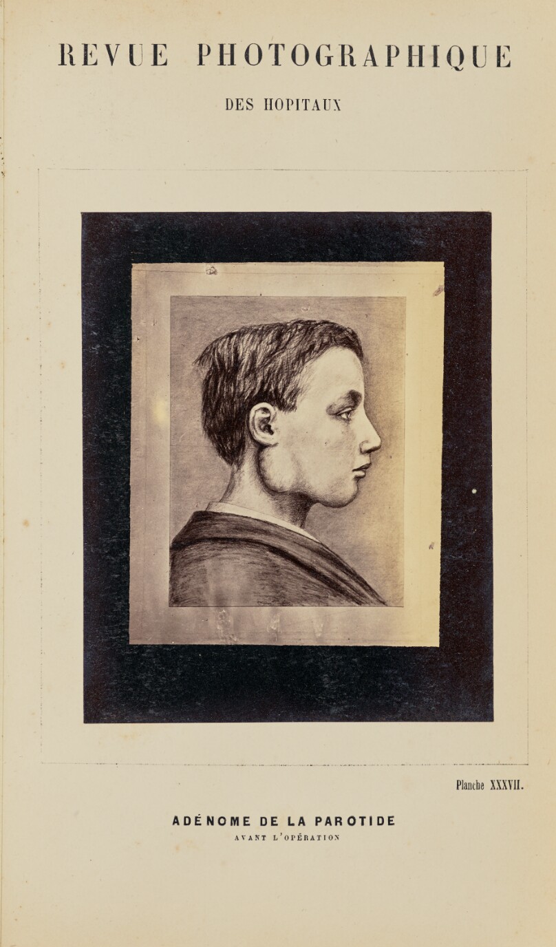 Adénome de la parotide, avant l'opération