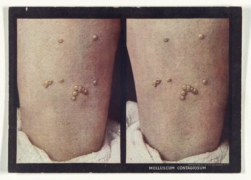 Molluscum Contagiosum