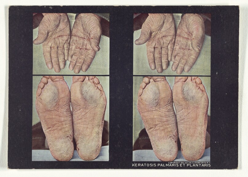 Keratosis Palmaris et Plantaris