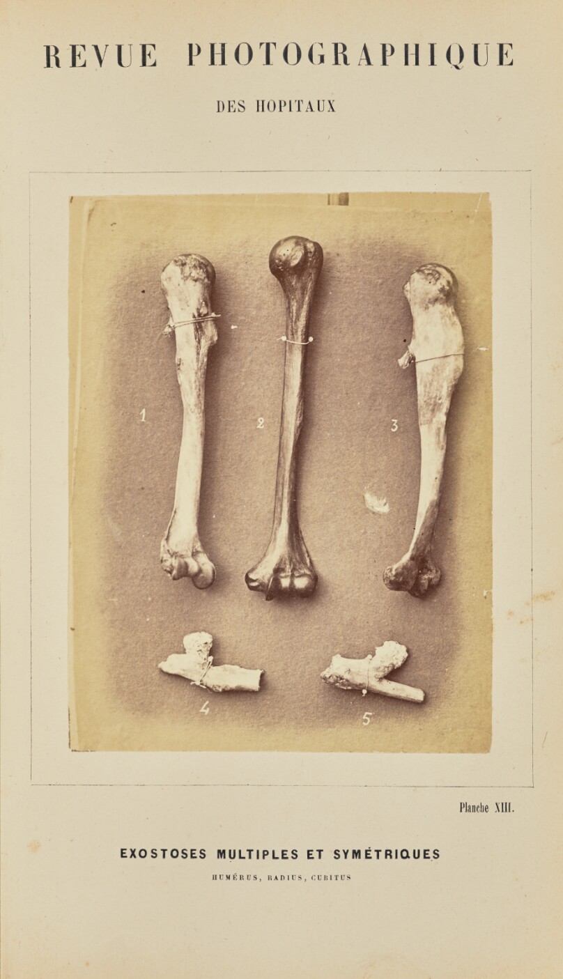 Exostoses multiples et symétriques, humérus, radius, cubitus