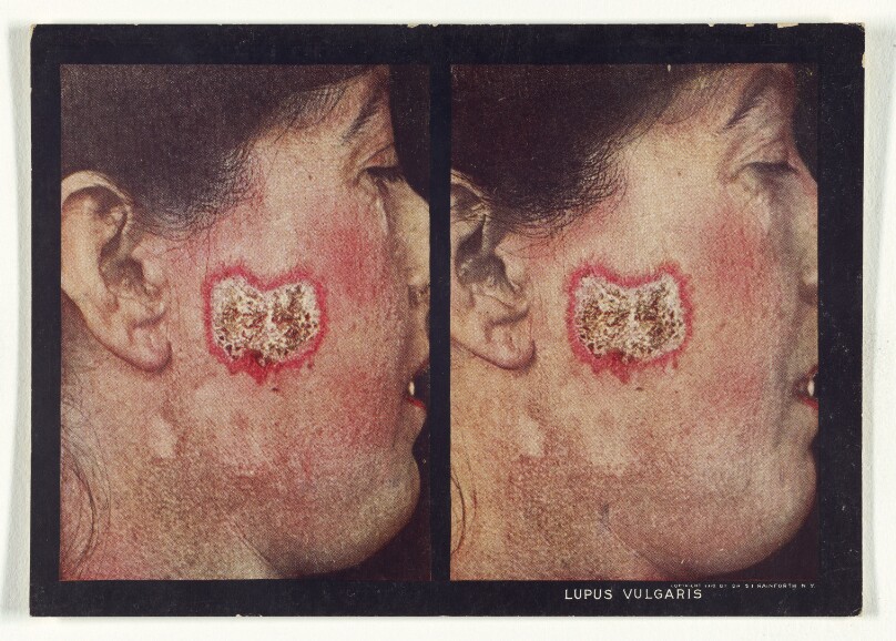 Lupus Vulgaris