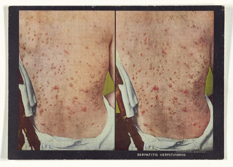 Dermatitis Herpetiformis