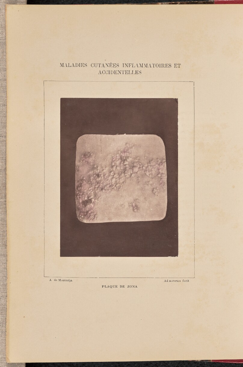 Plaque de zona