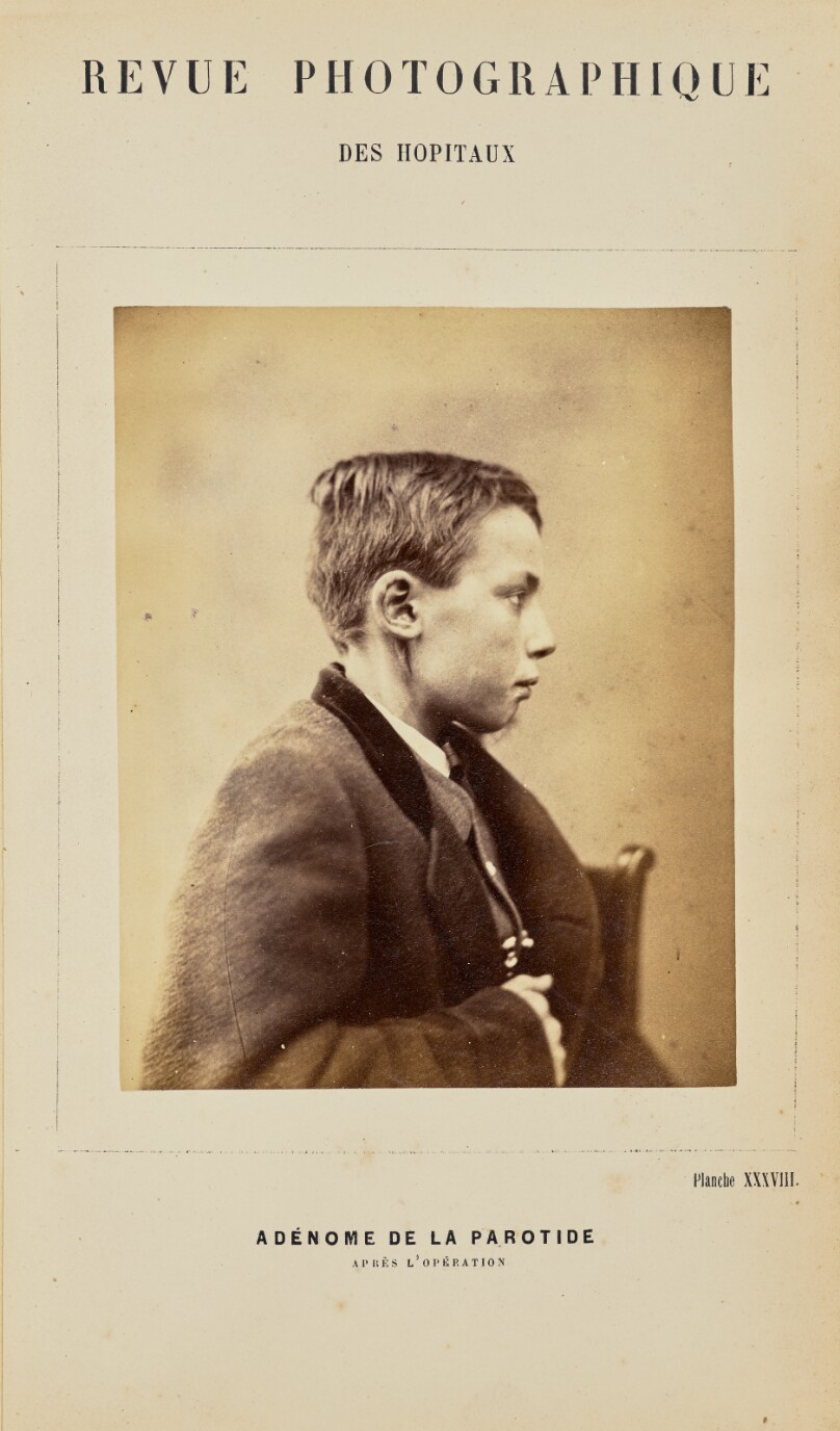 Adénome de la parotide, aprés l'opération