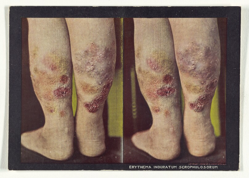 Erythema Induratum Scrofulosorum.
